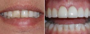 Patient came to us after ortho with significant wear on the upper front teeth and wanted to have homogeneous thickness and whiteness to the teeth. 4 top front veneers done in this case