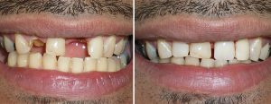 Patient came in with broken teeth; wanted an economical and quick replacement of the missing teeth in the front. an upper stayplate (interim partial) was done for him