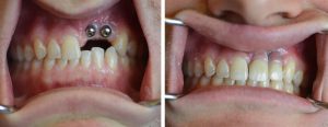 Patient came to us with implants having been placed at another office after a skateboarding accident, and with significant bone loss present. restored the implants with implant crowns