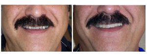 old crowns + partial -- change to more balanced crown/partial teeth