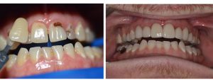 extensive extensive decay on top front teeth with mal-alignment --- 6 top front veneers