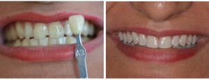 chipped front tooth - Express whitening + filling/bonding