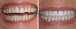 old porcelain fused to metal crown with dark margin showing in the front - change to all ceramic crown after whitening the teeth