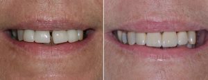 4 old crowned teeth, one with mobility and periodontal disease needing extraction --- single crown and a bridge done