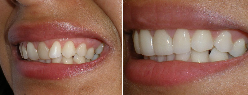 no-ortho treatment for misalignment - 4 veneers