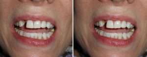 no-ortho treatment for misalignment - 4 veneers