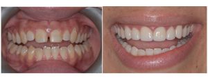Patient with small upper teeth relative to the size of the jaw - whitening + veneers on uppers only