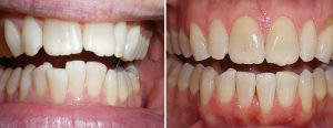 Invisalign