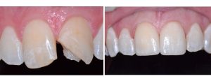 traumatic fracture of the front tooth - 2 veneers to address the fracture as well as the alignment of the right side front tooth