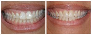 4 months of Invisalign