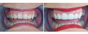 fixing the cant (uneven) smile line and reshaping the teeth