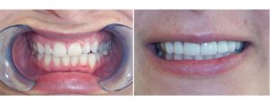 small top front teeth , pt wanted to reshape and made them wider. 4 front veneers done