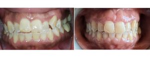 Invisalign for a skeletal class III