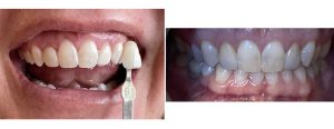 old veneers on peg (small) lateral incisors + gum recession on the right central --- changed the veneers on laterals + gum grafting on the central along with gum repositioning on the right lateral to create a harmonious gumline