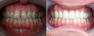 misaligned teeth with patched up fillings and gap -- 8 veneers on upper teeth only