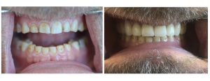 significant wear throughout with very porous teeth, pt wanted to address the uppers only for now -- upper veneers/crowns only at this point