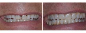 closure of gap with bonding/fillings materials