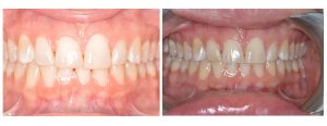 uneven edges of the top front teeth due to chipping and wear - whitening + reshaping of the teeth (enameloplasty)