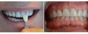 significant erosion on the front teeth along with gaps - 4 top veneers