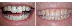 2 front old PFM crowns with gum recession and margin showing -- changed to all ceramic crowns