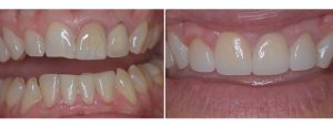 significant wear on the upper front teeth, pt wanting to reshape and even out the smile - 4 upper veneers done