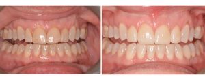 old veneers with marginal discoloration and chipping --- new veneers done to replace