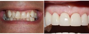 misalignment and uneven smile -- did Invisalign and veneers