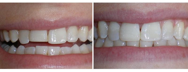 broken tooth - repaired with composite bonding
