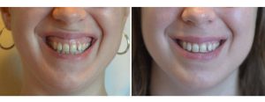 Botox used for addressing gummy smile!