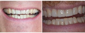 chipped and worn out front teeth in upper and lowers --- restored the lower one with bonding/filling materials while the uppers were done as veneers
