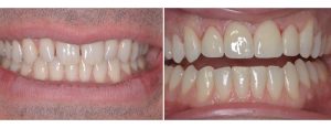 gaps and unevenly shaped upper front teeth -- restored with veneers
