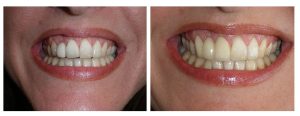 old cantilever bridge on front tooth replaced with all ceramic cantilever
