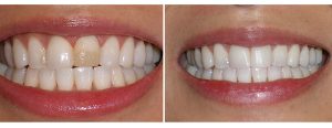 old discolored composite bonding replacement