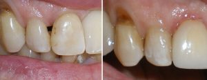 black triangle closure at the gum with composite bonding technique
