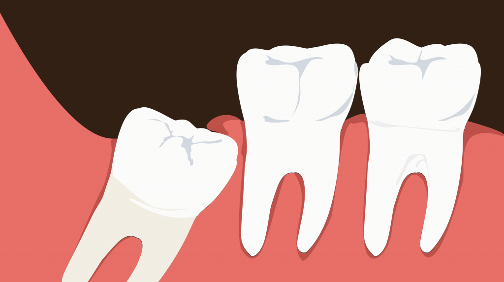 Wisdom Teeth Removal and Sedation