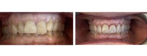 erosion case of upper teeth, addressed with 10 ceramic crowns