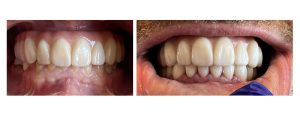 patient with an existing zirconia all-on-4 and significant wear on the lower teeth. restored the lower arch by opening the bite with zirconia crowns and a bridge