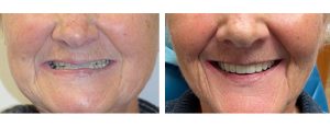 patient with existing denture on upper that did not show much of her teeth when smiling & unstable. all-on-4 fixed prosthesis done for the upper arch with longer teeth that show well when smiling while quite stable in her mouth!