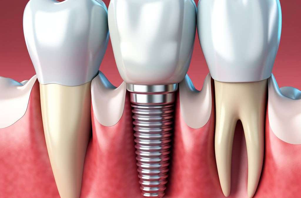 Dental Implants Procedure