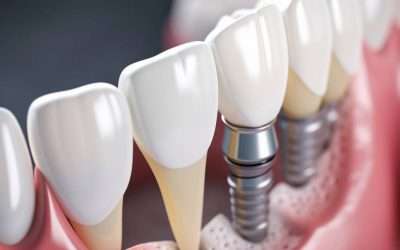 The True Cost of Dental Implants: What to Expect and How to Budget