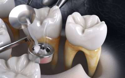 Wisdom Tooth Removal: What to Expect and How to Prepare