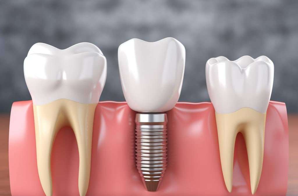 Tooth Implant vs Bridge Comparison