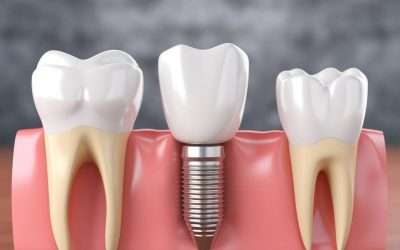 Tooth Implant vs. Bridge: Which Option is Best for Your Smile?