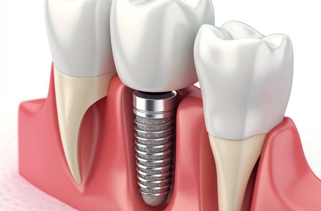 Dental Implants Procedure Image Description: A detailed illustration showing the process of dental implant placement, from the insertion of the titanium post into the jawbone to the attachment of the dental crown. The image also includes a side-by-side comparison of a natural tooth and a dental implant for better understanding.