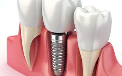“The Ultimate Guide to Dental Implants: Costs, Benefits, and More”